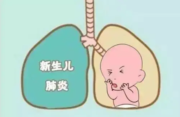 新生儿肺炎的早期症状及表现