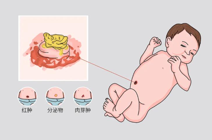 新生儿脐炎怎样护理脐部