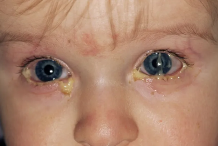 孩子得了结膜炎怎么办要注意什么(孩子患了结膜炎怎么办)