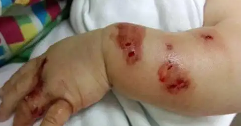 防止婴儿受到宠物的伤害的措施（婴儿被宠物咬伤怎么办）